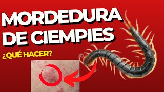 🔴Qué hacer si te muerde un CIEMPIÉS 🔴 Síntomas de mordedura de ciempiés [upl. by Ettenhoj]