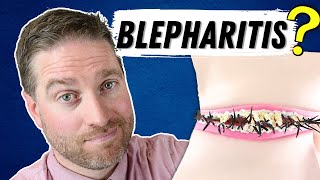 What Is Blepharitis Blepharitis Explained  Best Treatments [upl. by Enyawal]