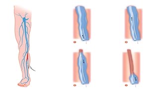 Les varices sontelles dangereuses pour la santé [upl. by Sager536]