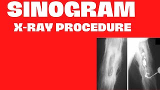 Xray Procedure SinogramSinogram Xray Procedure Test in RadiologyIn Urdu Hindi Easy Radiography [upl. by Tedmann279]