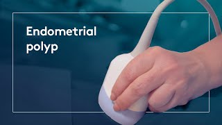 What is an Endometrial polyp [upl. by Einad625]