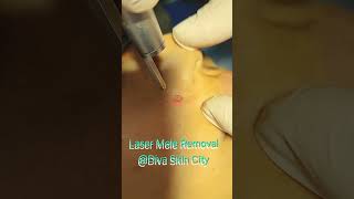 Laser Mole Removal [upl. by Enelaj]