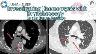 Investigating Haemoptysis with Bronchoscopy [upl. by Anitrak]