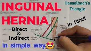 Inguinal Hernia Anatomy 12  Direct and Indirect Inguinal Hernia  Abdomen  Anatomy [upl. by Ylekalb]