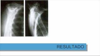 Posicionamento radiográfico dos membros superioreswmv [upl. by Gnivre]