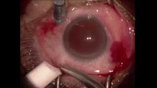 Vitrectomie pelage pour membrane epimaculaire  Vitrectomy for epiretinal membrane [upl. by Jillana698]