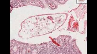 Histopathology AppendixPinworms [upl. by Derr999]