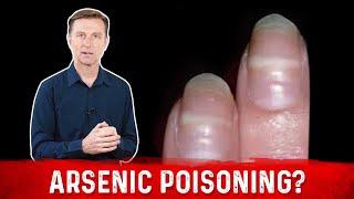 Identify Arsenic Poisoning Through Your Nails [upl. by Aisirtap]