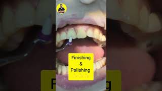 chipped tooth repair front tooth teeth dentist shortsfeed dental [upl. by Ailehc471]