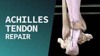 Achilles Tendon Repair [upl. by Eng693]