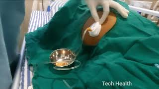 Ascitic Tapping Procedure In Hindi  Ascites Tapping Diagnostic and Therapeutic  how to tap [upl. by Lindsy]