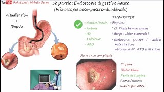 ULCÈRES GASTRIQUE ET DUODÉNAL  3è Partie  Endoscopie digestive haute FOGD [upl. by Allesor]