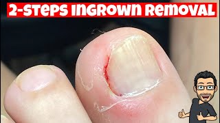 HOW TO REMOVE AN INGROWN TOENAIL [upl. by Ecinrahs]