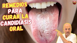 🆘 CANDIDIASIS EN LA BOCA ¿COMO SE CURA CON REMEDIOS CASEROS 🆘 [upl. by Adin]