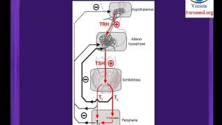 Hypothyroidie comment reconnaitre goitre debutant Glande thyroïdienne nodulaire symptomes nodule [upl. by Ihcego]