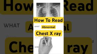 Abnormal Chest Xray Interpretation in 2 Minutes How to Read Abnormal Chest Xrays trending neet [upl. by Eirffej566]