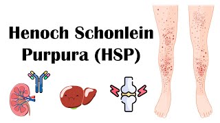 Henoch Schoenlein Purpura HSP  Causes Pathophysiology Diagnosis And Treatment [upl. by Zobias245]