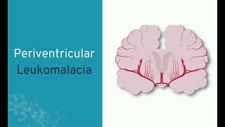 PVL Periventricular leukomalacia mrcpch Communication [upl. by Thorn90]