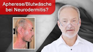 AphereseBlutwäsche bei Neurodermitis  ein Patientenfall begleitet durch NICOSanierung [upl. by Nelon]