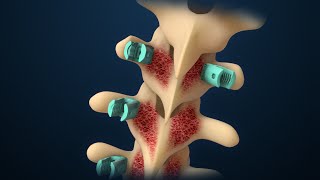 Scoliosis  Scoliosis Surgery  Nucleus Health [upl. by Milas]