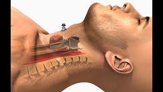 tracheostomy selflessmedicose CompleteAnatomyElsevier [upl. by Kered]