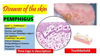 Pemphigus Vulgaris  HISTOPATHOLOGY  Immunofluorescence  Treatment  PART 22 [upl. by Silda]