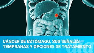 ¡CÁNCER de COLON SÍGNOS y SÍNTOMAS de ALERTA que NUNCA DEBES IGNORAR [upl. by Suoiluj351]