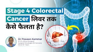 Stage 4 Colon amp rectal Cancer लिवर तक कैसे फैलता है  Stage 4 Cancer Explained  Dr Praveen Kammar [upl. by Driscoll]