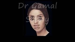 Diplopia  ازدواج الرؤية [upl. by Gavette]