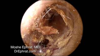 Ear Wax Removal [upl. by Schenck]