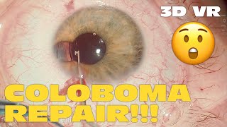 3D Phaco Clip 174  Hard Nucleus CTR and Iris Coloboma Repair VR Headset Version [upl. by Enelear]