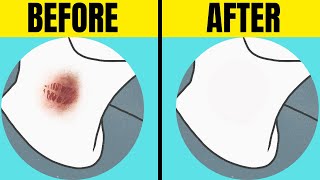 HOW to GET RID of Hickeys PROVEN Removal Techniques [upl. by Othella]