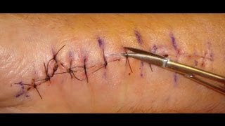 Suture Removal Protocol [upl. by Nylesoj]