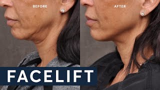 Nonsurgical Facelift  Profound RF [upl. by Nodnelg]