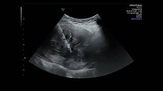 Ultrasound guided microwave ablation for uterine myoma [upl. by Nonac]