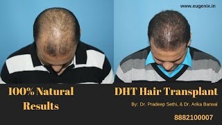 Hair transplant Surgery in India at Eugenix Hair Transplant Sciences [upl. by Wearing]