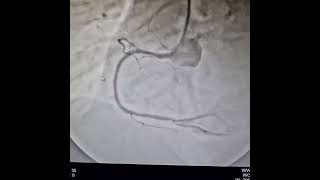 Primary PTCA and Stenting to 100 blocked RCA with large thrombus burden  Agra Heart Center  Best [upl. by Anirtruc]