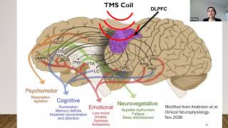 Transcranial Magnetic Stimulation for TreatmentResistant Depression [upl. by Jasisa]