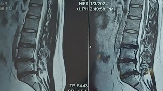 Always be happy L4 L5 S1 Disc bulgeDisc decompression lower back surgery Disc Break after surgery [upl. by Htiekram]