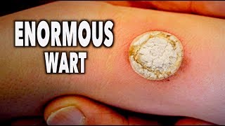 ENORMOUS WART vs LIQUID NITROGEN like seriously big  Dr Paul [upl. by Quirita]