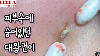 피부🧴속에 숨어있던🧐 대왕건이🤙 여드름압출 [upl. by Ynehteb719]