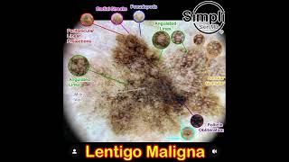 Lentigo Maligna Melanoma [upl. by Ecinrahs]