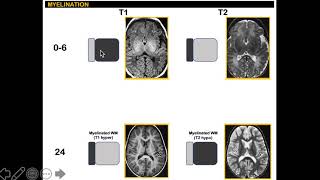 Myelination in MRI 14 simplified [upl. by Dexter]