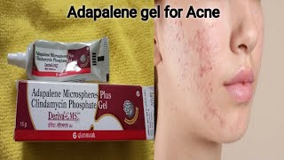 Adapalene gel Reviewin Telugu How much effective it is for Acneamp pimplesDeriva CMS gel [upl. by Aikim]