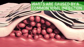 What are plantar warts [upl. by Dressel]