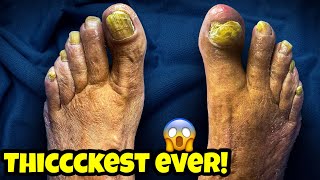 THICK YELLOW TOENAILS 🤯 [upl. by Attenauqa]