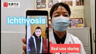 Ichthyosis real case sharing ichthyosis skincare dermatologist dryskinremedy [upl. by Ztnarf]