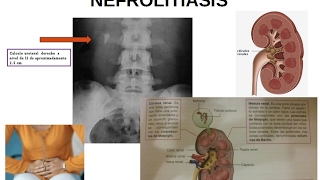 FISIOPATOLOGÍA URINARIA Litiasis renal o nefrolitiasis piedras en el riñón [upl. by Py582]