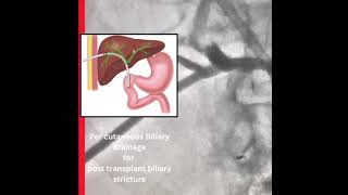 PTBD Treatment in Hyderabad  DR Suresh Giragani [upl. by Esenej]