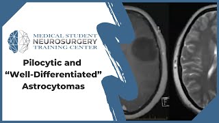 Pilocytic and “WellDifferentiated” Astrocytomas [upl. by Ynohtnaleahcim]